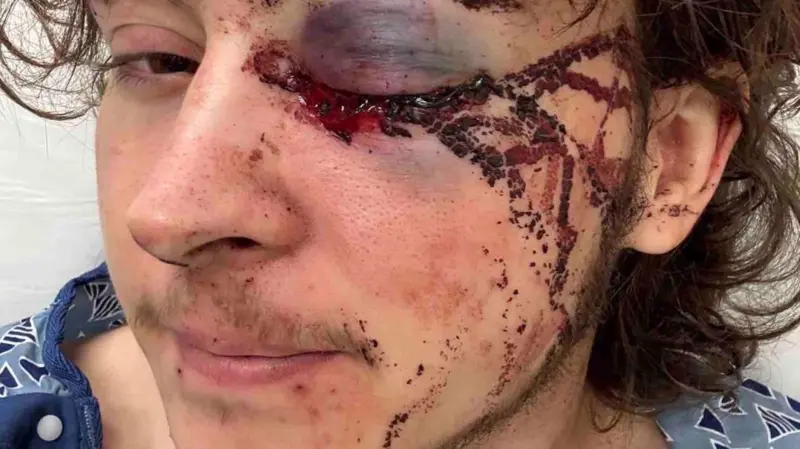 Joven de California pierde un ojo durante protesta contra ICE