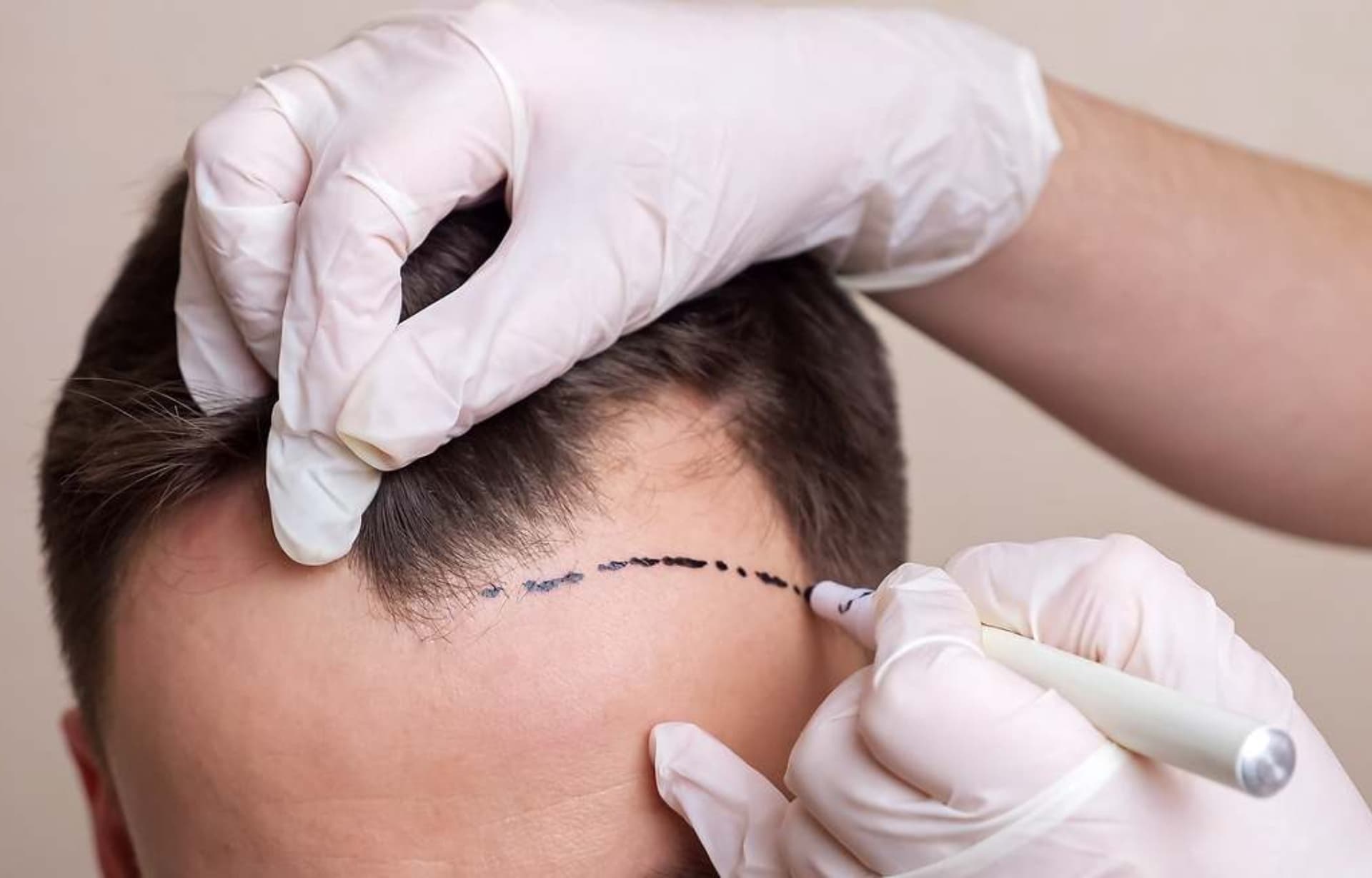 Innovación en Trasplante Capilar: Spiro Revoluciona el Sector en Venezuela